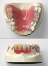 プラスチック義歯 (保険適用)