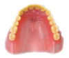 プラスチック義歯 (保険適用)