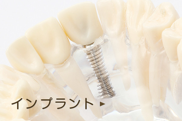 インプラント