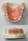 ノンクラスプ床義歯